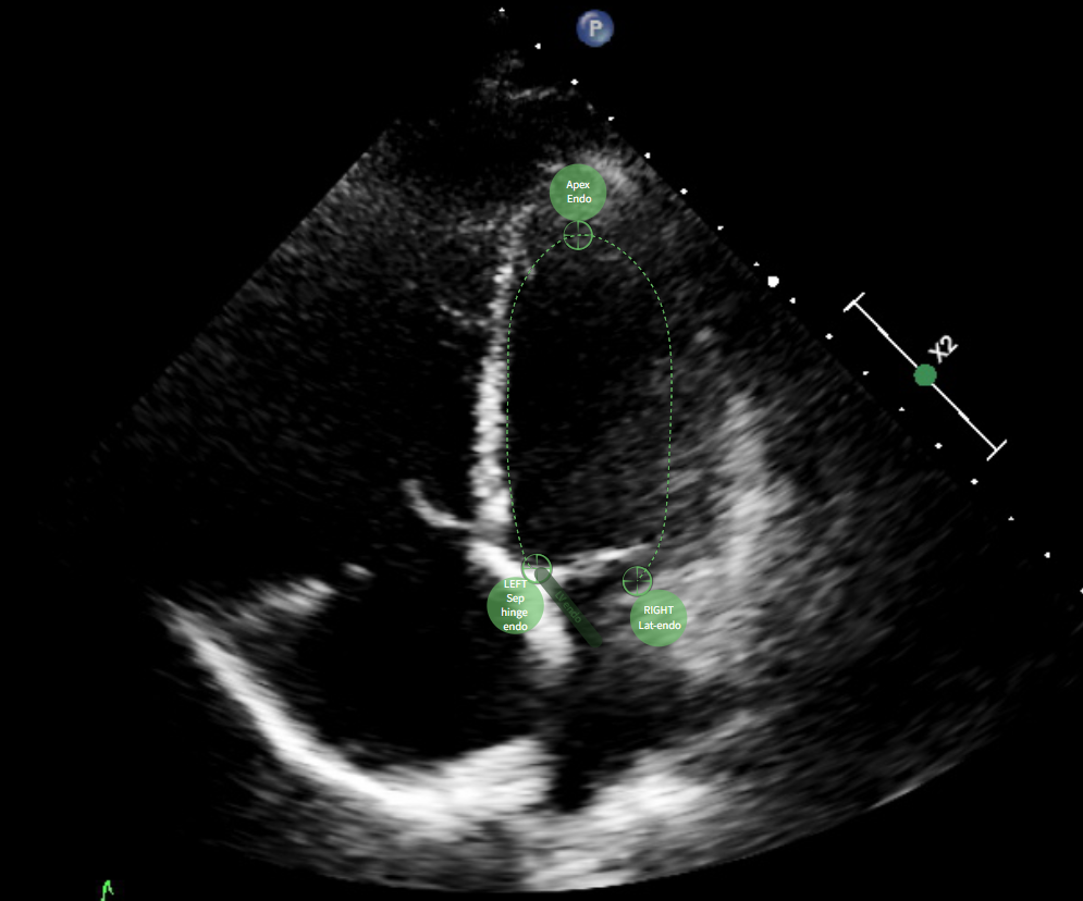 A4CH Endocardial LV Border Example